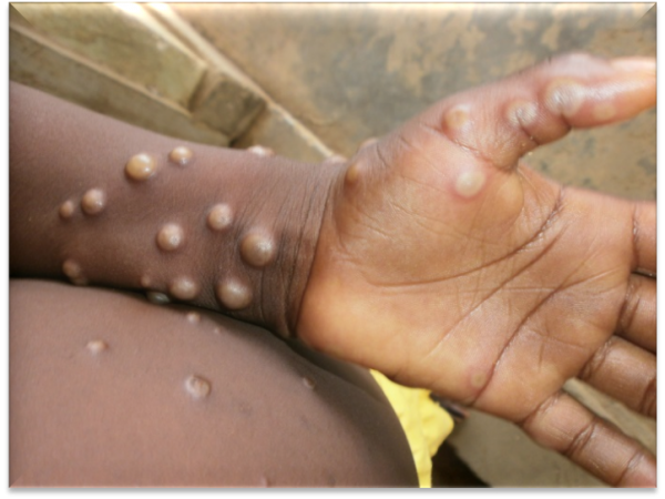 Edo confirms eight cases of monkeypox