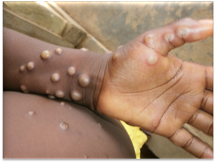Edo confirms eight cases of monkeypox Edo confirms eight cases of monkeypox